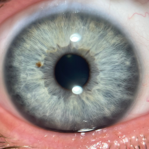 consultation iridologie